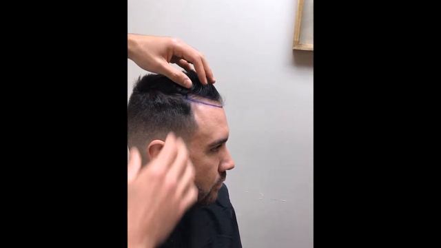 Key Points for Natural Results in Men's Hairline Transplantation | Dr. Anthony Bared, MD, FACS Miam смотреть онлайн