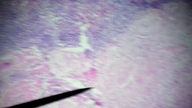 22 TB lymphnode смотреть онлайн