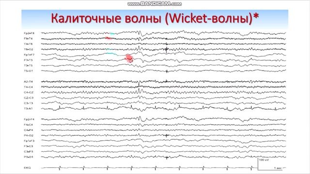 Нормальное ЭЭГ сна смотреть онлайн