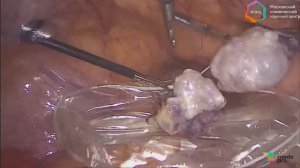 «Лапароскопическая двусторонняя аднексэктомия»