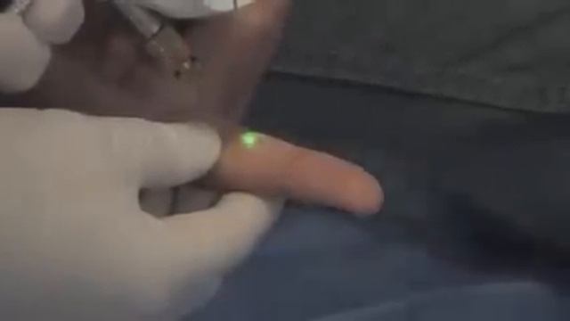 Brymill Cry-Ac Tracker from Henry Schein смотреть онлайн