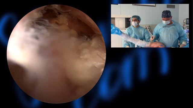 Артроскопический якорный шов частичного разрыва сухожилия надостной мышцы смотреть онлайн