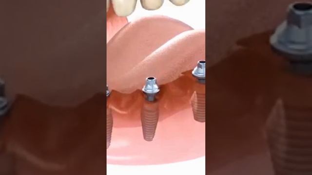 Implant смотреть онлайн