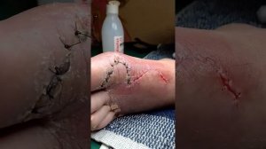 Как самостоятельно снимать швы