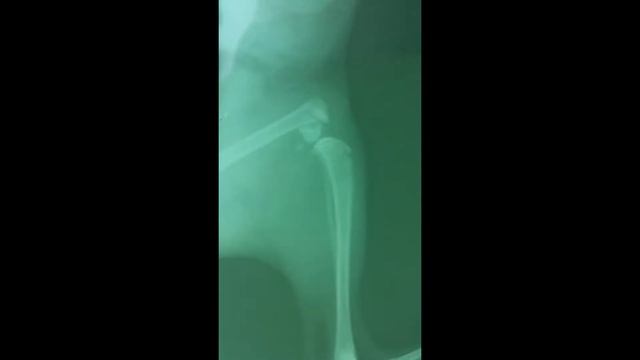 полный внутрисуставной перелом дистальной части бедренной кости смотреть онлайн