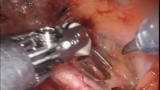 Sentinel node Mapping In Endometrial Carcinoma - Yogesh Kulkarni смотреть онлайн