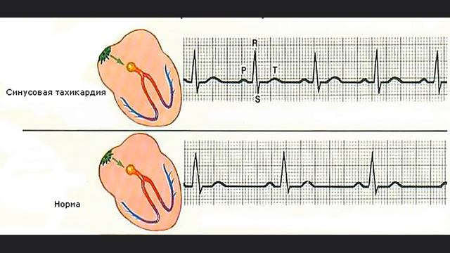 Психосоматика тахикардии смотреть онлайн