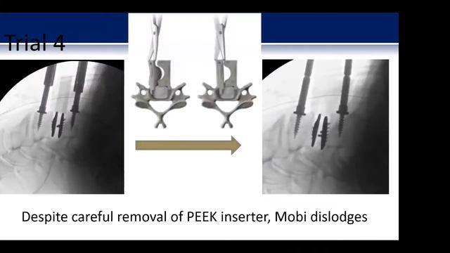 Intraoperative Failure of Total Disc Replacement presented by Daniel Reid, MD смотреть онлайн