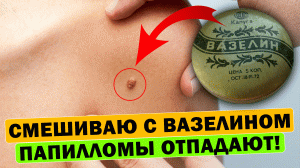 Папилломы, бородавки, кондиломы и другие образования на коже боятся этого средства! #папилломы