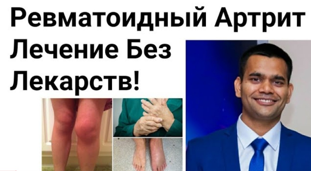 Ревматоидный Артрит- Лечение Без Лекарств