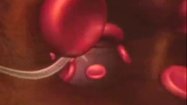 Malaria: No Ordinary Mosquito Bite смотреть онлайн