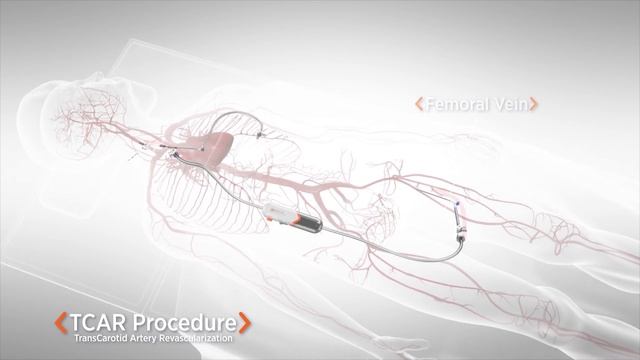 TCAR | TransCarotid Artery Revascularization Procedure Narrated Animation | Silk Road Medical | 4mi