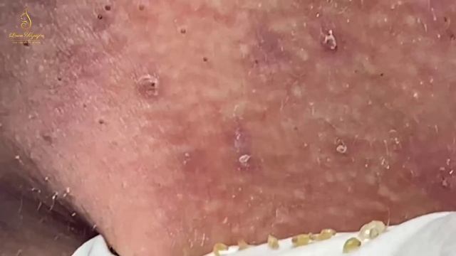 Best blackhead extraction on the face (155) | Loan Nguyen смотреть онлайн