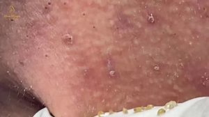 Best blackhead extraction on the face (155) | Loan Nguyen