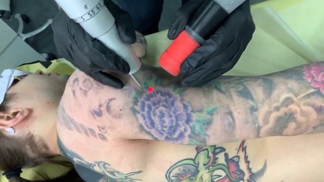 Удаление рукава. Студия ET.LASER. смотреть онлайн