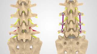 Транспедикулярная фиксация позвоночника (ТПФ)
