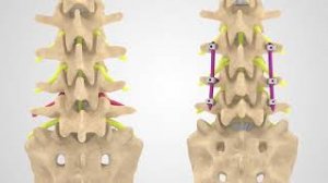 Транспедикулярная фиксация позвоночника (ТПФ)