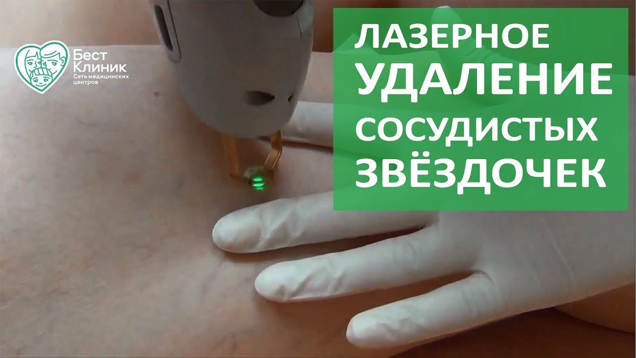 Удаление сосудов лазером. Удаление сосудистых звёздочек лазером. Бест Клиник. смотреть онлайн