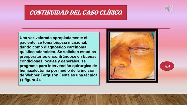 carcinoma ex-adenoma pleomorfo смотреть онлайн