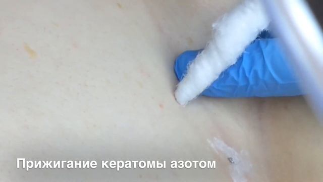 Криодеструкция кератомы
