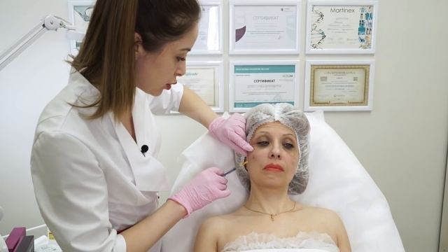 Коррекция средней трети лица- носослезной и среднещечной бороды филлером, до и после