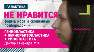 Уменьшающая ринопластика + гениопластика I Свиридов Максим Константинович #ринопластика