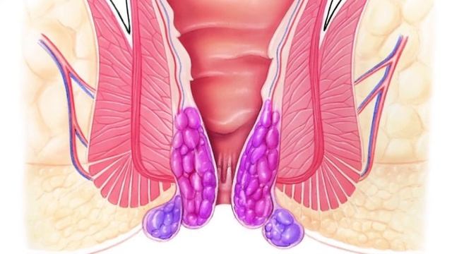 Лигирование внутренних геморроидальных узлов смотреть онлайн