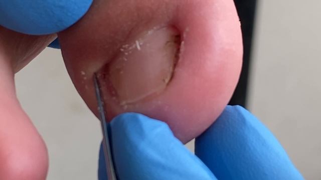 Amazing pedicure video! So much dirt on toenails！【Xue Yidao】 смотреть онлайн