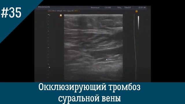 УЗИ вен. Окклюзирующий тромбоз суральной вены. смотреть онлайн