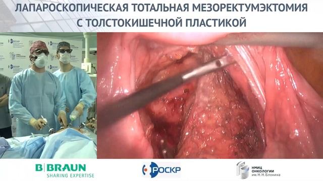 Лапароскопическая тотальная мезоректумэктомия с формированием толстокишечного резервуара смотреть онлайн