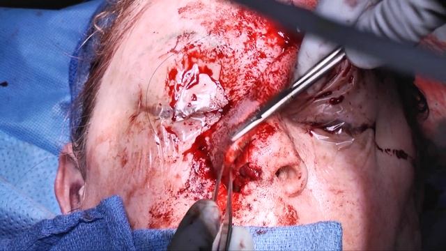 Paramedian Forehead Flap for Nasal Reconstruction смотреть онлайн