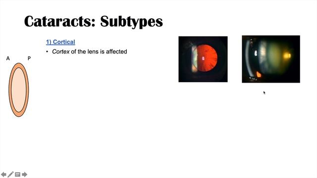 Cataracts | Causes, Risk factors, Subtypes (Cortical, Nuclear, Posterior subcapsular), Treatment смотреть онлайн
