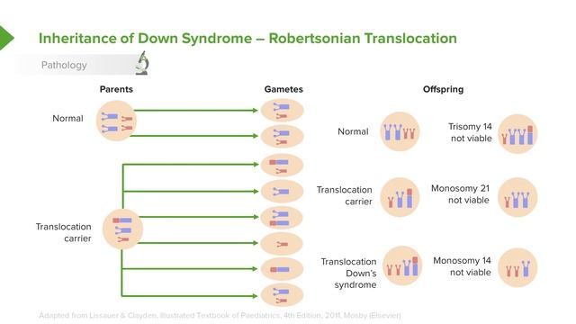 Trisomy 21 (Down Syndrome): Introduction – Pediatrics | Lecturio