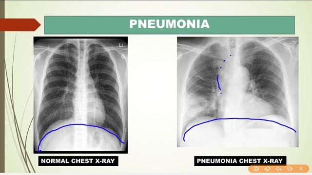 Interpret chest x ray || Basic chest X Ray||सामान्य चेस्ट एक्स रे |Hindi में आसानी से समझे||Tb ches смотреть онлайн