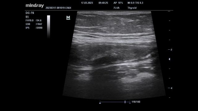 УЗИ ОБП. Аппендицит.