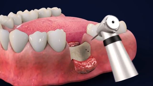 How to Perform Dental Implants by MIS -Tutorial (3D Dental Animation) смотреть онлайн