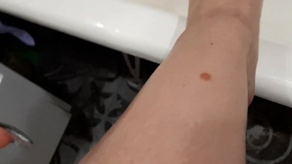 Удаление вросших волос