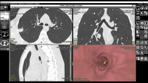 Обучающее видео. Программа «Виртуальная бронхоскопия»