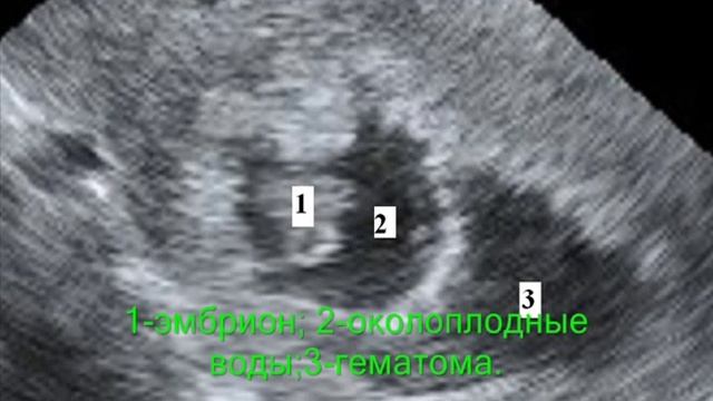 Ретрохореальная гематома смотреть онлайн