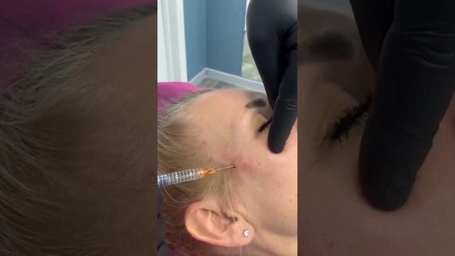 Коррекция скуловой зоны филлерами, с помощью атравматической канюли. Обучение косметологов. смотреть онлайн