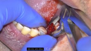 удаление зуба