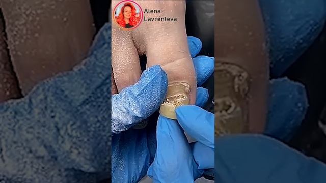 Толстый желтый ноготь! Что делать? Ответ в полном видео! Уже смотрели на канале? #nails #shortsvide смотреть онлайн