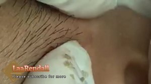 Удаление черных точек, полное видео от доктора Lalit Kasana, часть 9