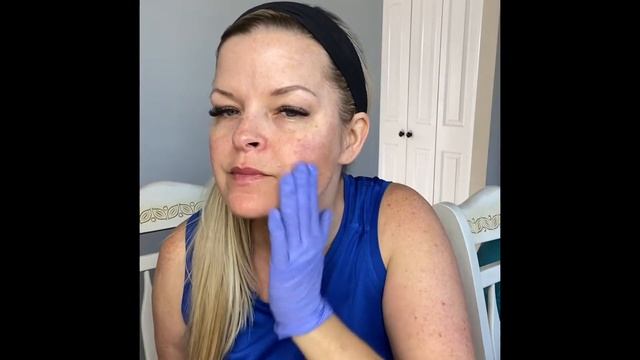 Bienpeel~ 35% TCA Peel ~ 4th Treatment ~ Does it WORK?! смотреть онлайн