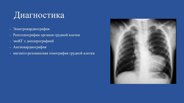 Тетрада Фалло (общий обзор порока смотреть онлайн