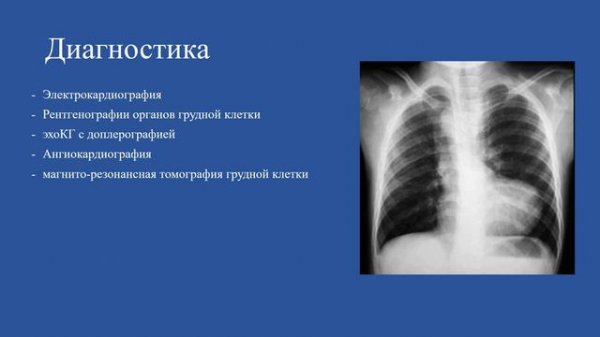 Тетрада Фалло (общий обзор порока