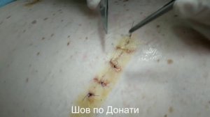 Снятие различных видов швов (по Холстеду, по Донати, по Альговеру)