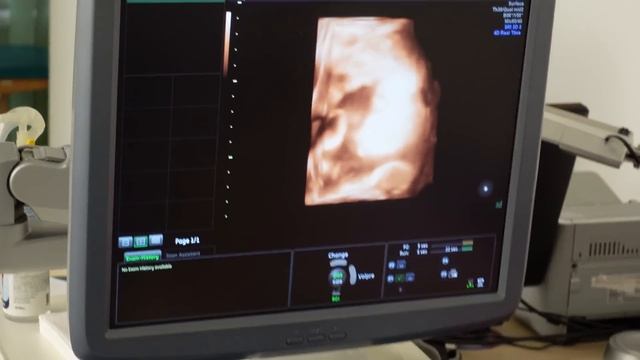УЗИ 32 недели беременности смотреть онлайн