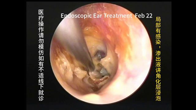 Review and cleaning of two types of cholesteatoma смотреть онлайн