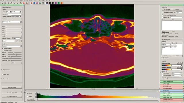 Non-planar slices of the registered CT/MRI data using 2D and 3D visualization смотреть онлайн